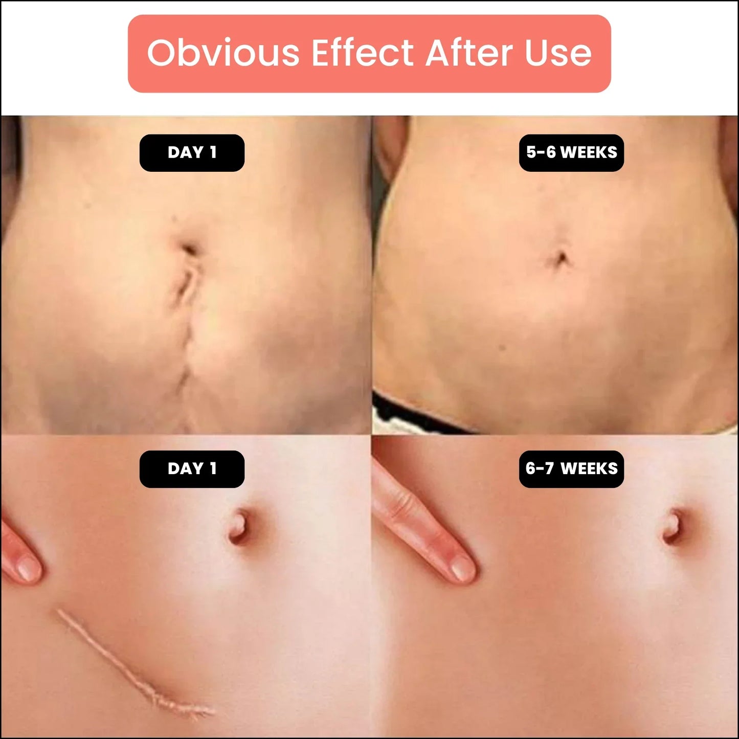 Silicone Scar Tape – For Scars from Surgery, Acne, Burns & More