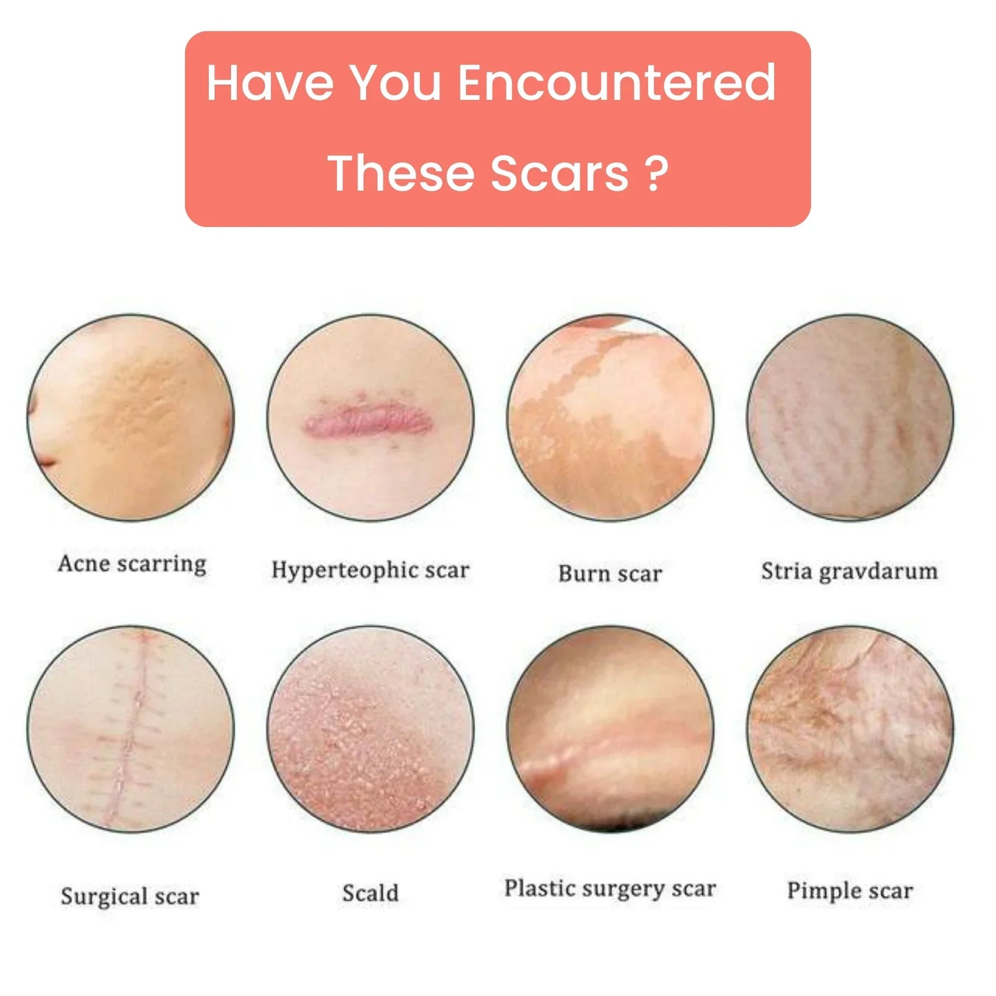 Silicone Scar Tape – For Scars from Surgery, Acne, Burns & More