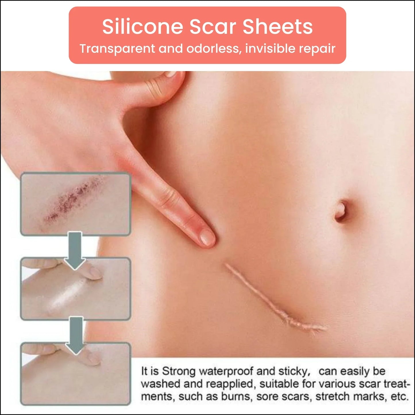 Silicone Scar Tape – For Scars from Surgery, Acne, Burns & More